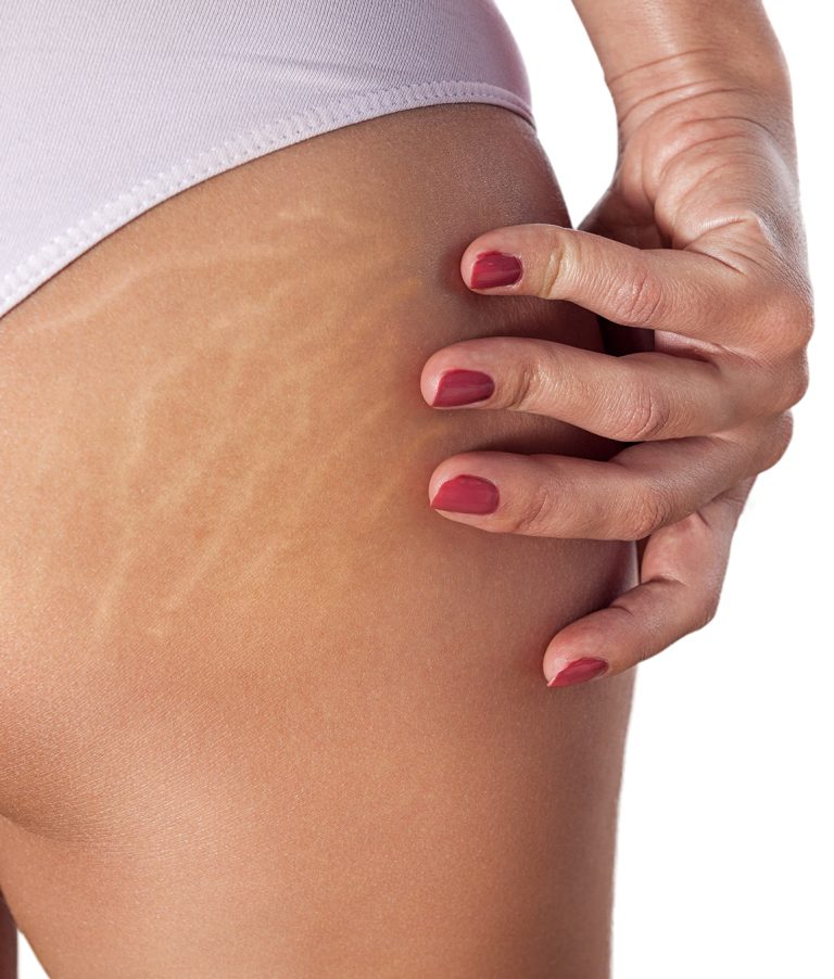 Are you battling stretch marks?